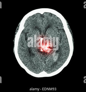 CT-Scan des Gehirns: hämorrhagischen Schlaganfall zeigen Stockfoto