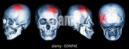 CT-Scan des menschlichen Schädels und 3D mit Schlaganfall (Apoplexie) Stockfoto