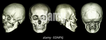 CT-Scan des menschlichen Schädels und 3D Stockfoto