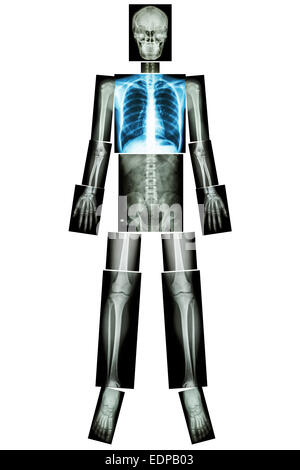 Gesunde Lunge (Röntgen-Ganzkörper: Schädel Kopf Hals Wirbelsäule Schulter Brust Thorax Lunge Lunge Herz Rippe Arm Ellenbogen Unterarm Handgelenk ha Stockfoto