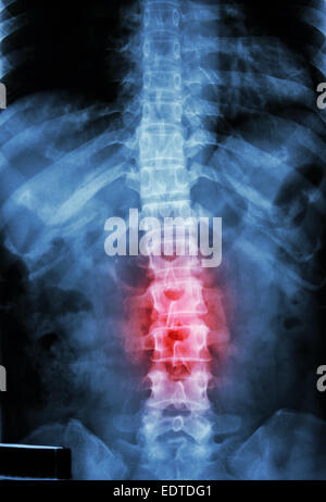 Röntgen-T-L Wirbelsäule (Brust-Lenden-Wirbelsäule) zeigen Film: menschliche Brust-Lenden-Wirbelsäule und Entzündung an der Lendenwirbelsäule Stockfoto