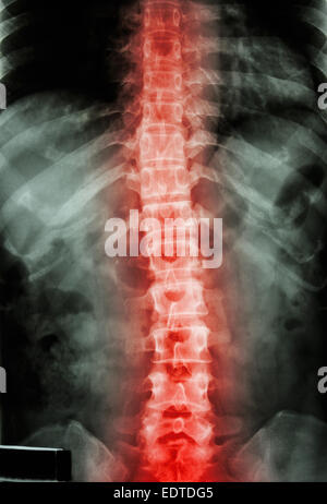 Röntgen-T-L Wirbelsäule (Brust-Lenden-Wirbelsäule) zeigen Film: Thorax-Lendenwirbelsäule Wirbelsäule und Entzündung an der Wirbelsäule des Menschen Stockfoto
