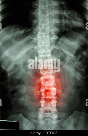 Röntgen-T-L Wirbelsäule (Brust-Lenden-Wirbelsäule) zeigen Film: menschliche Brust-Lenden-Wirbelsäule und Entzündung an der Lendenwirbelsäule Stockfoto