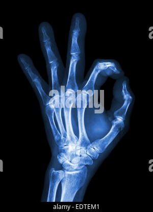 X-ray Hand mit OK symbol Stockfoto