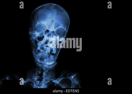 Film Röntgen Schädel und leeren Bereich auf der rechten Seite Stockfoto
