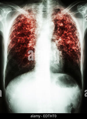 Röntgen der Film interstitielle Infiltrat zeigen beide Lungen durch Mycobacterium-Tuberkulose-Infektion (Lungentuberkulose) Stockfoto