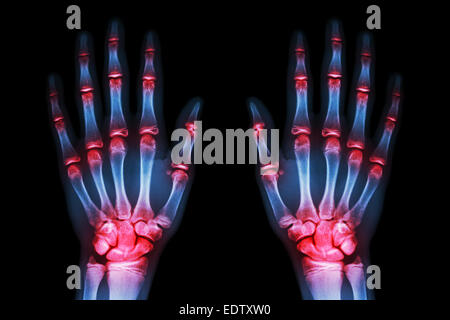 mehrere gemeinsame Arthritis Hände (Gicht, rheumatoide) auf schwarzem Hintergrund Stockfoto