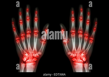 mehrere gemeinsame Arthritis Hände (Gicht, rheumatoide) auf schwarzem Hintergrund Stockfoto