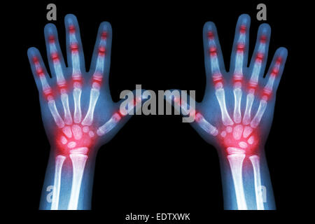 Rheumatoide Arthritis (x-ray Kinderhände und mehrere Gelenkarthrose) Stockfoto