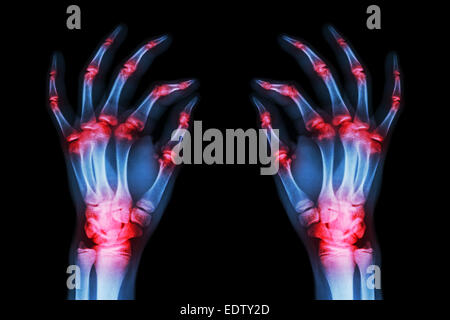 mehrere gemeinsame Arthritis Erwachsener beidhändig (Gicht, rheumatoide) auf schwarzem Hintergrund Stockfoto