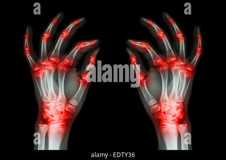 mehrere gemeinsame Arthritis Erwachsener beidhändig (Gicht, rheumatoide) auf schwarzem Hintergrund Stockfoto