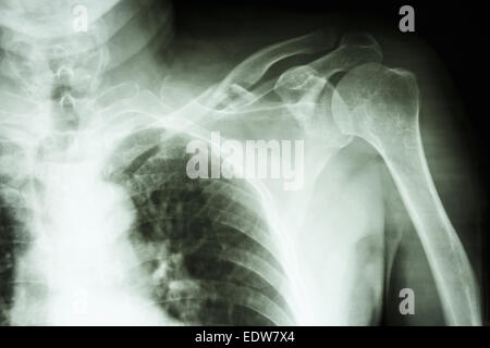 x-ray Filmschau zerkleinerte Fraktur mittleren Drittel links clavile Stockfoto