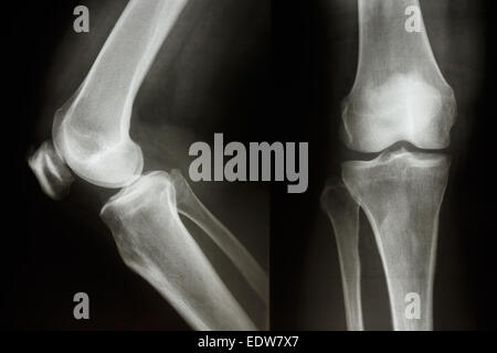 Der Roentgenfilm zeigen normale Knie joint(AP/Lateral) Stockfoto