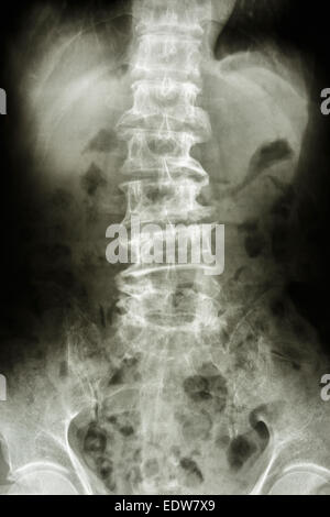 Film x-ray Show gebogen, Lendenwirbelsäule und Ausläufer der alten Menschen (Spondylose Patient), (Wirbelsäule) Stockfoto