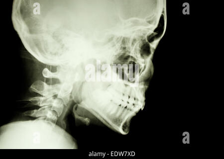 Der Roentgenfilm zeigen normale Schädel und Halswirbelsäule im lateralen Seite (isoliert) Stockfoto