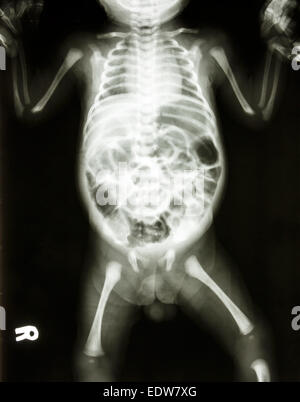 x-ray Film zeigen normale Skelett des Säuglings Stockfoto