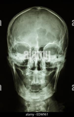 Film-Schädel AP(antero-posterior) zeigen normale menschliche Schädel Stockfoto