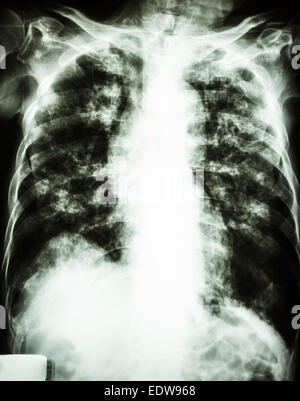 Röntgen der Film zeigen interstitielle Infiltrate und alveoläre Infiltrate beider Lunge durch Mycobacterium-Tuberkulose-Infektion (Pul Stockfoto