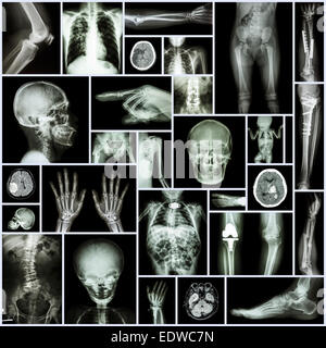 Kollektion x-ray Teil menschlichen, orthopädische Operation, mehrere Krankheiten (Fraktur, Gicht, rheumatoide Arthritis, Arthrose Knie, Str Stockfoto