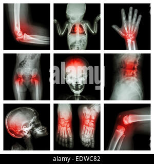 Kollektion x-ray Teil des Kindes und mehrere Verletzungen Stockfoto