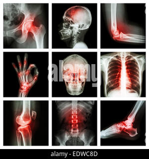 Kollektion Röntgen- und mehrere Verletzungen Stockfoto