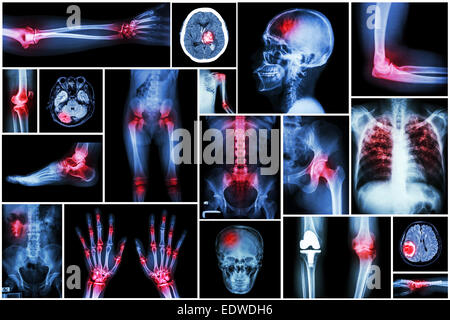 Kollektion Röntgen mehrere Krankheiten (Schlaganfall, Gehirntumor, Arthritis, Gicht, Rheuma, Nierensteinen, Lungentuberkulose, etc.) Stockfoto