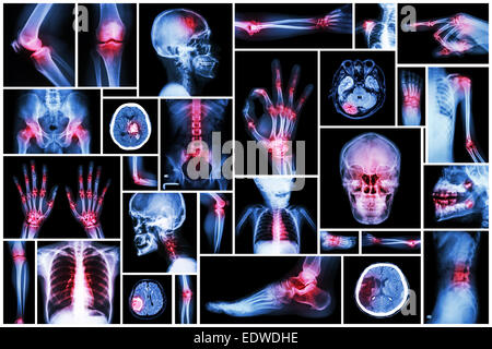 X-ray mehrere Teile des Menschen mit mehreren Erkrankungen (Schlaganfall, Arthritis, Gicht, Rheuma, Gehirn Tumor, Arthrose, etc.) Stockfoto