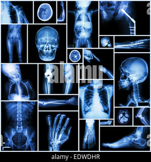 Kollektion x-ray "Mehrere Teil des Menschen", "Orthopädie" und "Mehrere Krankheit" (Fraktur, Luxation, Osteoarthr der Schulter Stockfoto