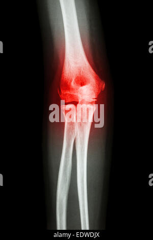 X-ray menschlicher Ellenbogen und Arthritis (Gicht, rheumatoide) Stockfoto