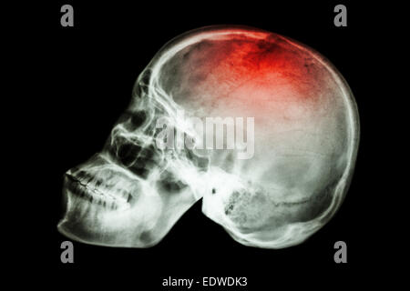 Röntgen Schädel seitlich mit "Schlaganfall" Stockfoto