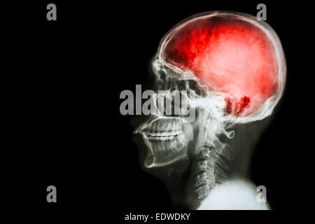Röntgen Sie Schädel & Halswirbelsäule (Lateral) mit "Schlaganfall" Stockfoto