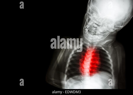 X-ray Körper des Kindes mit "Angeborene Herzfehler" Stockfoto