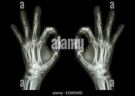 X-ray Hände mit OK Sign. Stockfoto