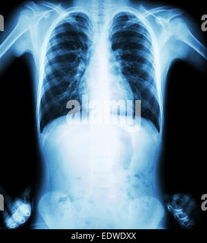 X-ray Brust (angewinkelten Position) (Frontansicht) Stockfoto