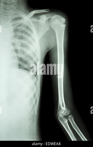 Film x-ray linke Schulter Stockfoto