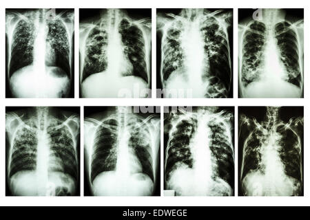 Sammlung von Röntgen-Thorax "Lungentuberkulose" Stockfoto