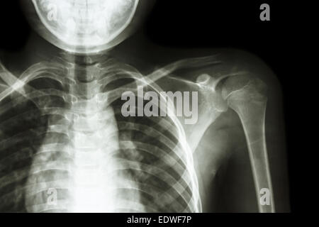 Film x-ray linke Schulter Stockfoto