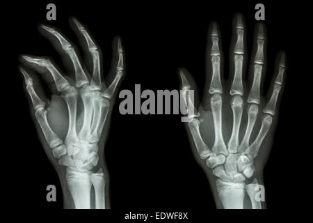 x-ray Hand AP/schrägen Film: normaler Mensch Hand zeigen Stockfoto