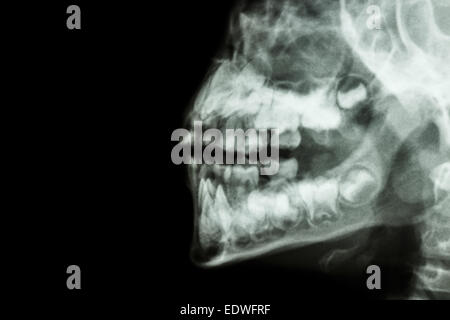 Film x-ray menschliche Kiefer und Zähne und leeren Bereich auf der linken Seite Stockfoto