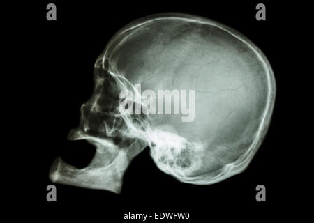 alte im Alter von der asiatischen Schädel (Thais), (keine Zähne) Stockfoto