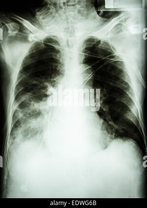 "Lungenentzündung mit respiratorischer Insuffizienz" Film Röntgen-Thorax des Patienten mit Endotrachealtubus, Katheter. Er wurde auf der Intensivstation behandelt. Stockfoto