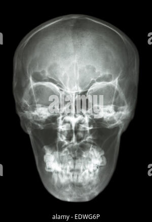 Asian Schädel (Thais) Stockfoto