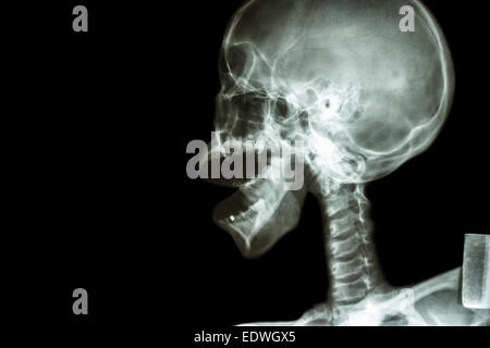 X-ray asiatischen Schädel und offenem Mund Stockfoto