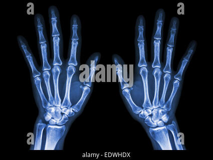 Film x-ray beide Hand-AP: zeigen normale menschliche Hände auf schwarzem Hintergrund (isoliert) Stockfoto