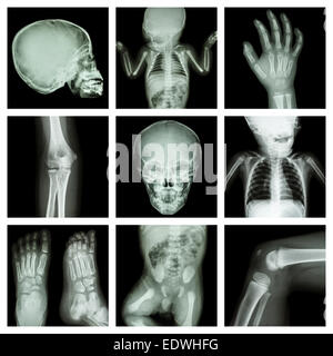 Kollektion x-ray Teil der Körper des Kindes (Version 2) Stockfoto