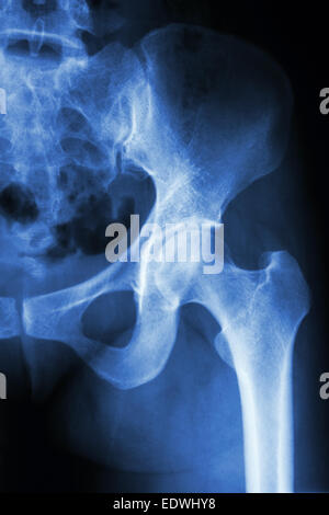 Film x-ray linke Hüfte: normaler Mensch Hüfte zeigen Stockfoto