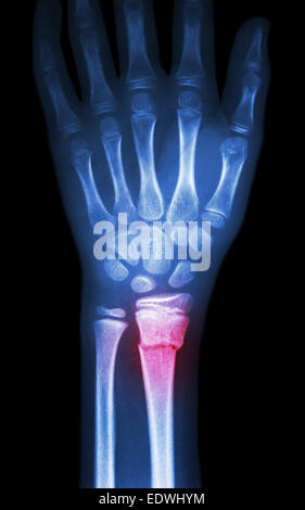 Fiilm Röntgen Handgelenk zeigen Fraktur distale Radius (Unterarm Knochen) Stockfoto