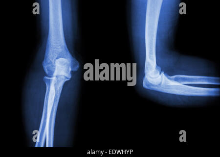 Film Röntgen Ellenbogen AP(Antero-posterior)/lateral Stockfoto