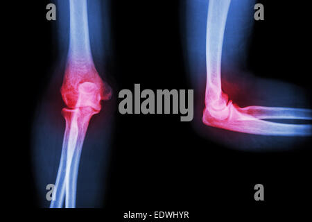 Film Röntgen Ellenbogen mit Arthritis (rheumatoide, Gicht) Stockfoto