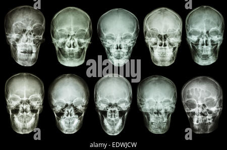 Sammlung von asiatischen Schädel (Ansicht von ventral) (Thais) Stockfoto